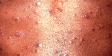 Syphilis Cases In Babies On Increase In Canada