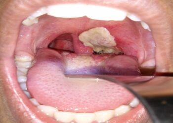 Diphtheria Kills 520 Children In Kano