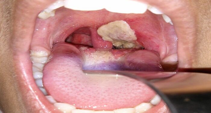 Diphtheria Kills 520 Children In Kano