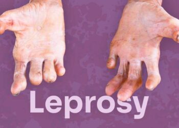 In Nigeria, Over 8.3% New Cases Of Leprosy Found In Children Below 15 years – NMA