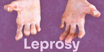 In Nigeria, Over 8.3% New Cases Of Leprosy Found In Children Below 15 years – NMA