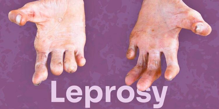In Nigeria, Over 8.3% New Cases Of Leprosy Found In Children Below 15 years – NMA