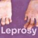In Nigeria, Over 8.3% New Cases Of Leprosy Found In Children Below 15 years – NMA