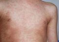 Measles Outbreak Kills 42 Persons In Adamawa