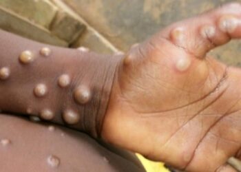 Abia State Records First Case Of Monkeypox