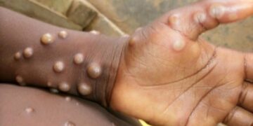 Abia State Records First Case Of Monkeypox