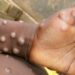 Abia State Records First Case Of Monkeypox